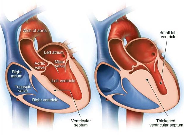 Ilustração (esquerda) de um coração normal e coração com miocardiopatia hipertrófica.