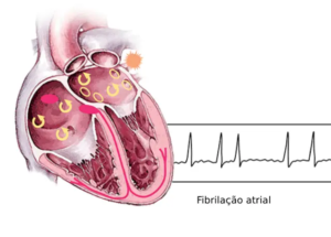 fibrilação atrial