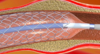 Angioplastia: o que é, para que serve e como é feita