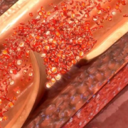 Dissecção da aorta