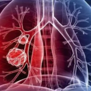 Hipertensão arterial pulmonar